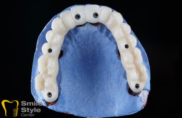 All on 6 dental implant in Antalya, Turkey