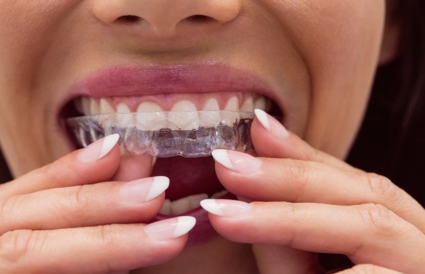 Dental plaque, Invisible Braces, Teeth AlignerTurkey